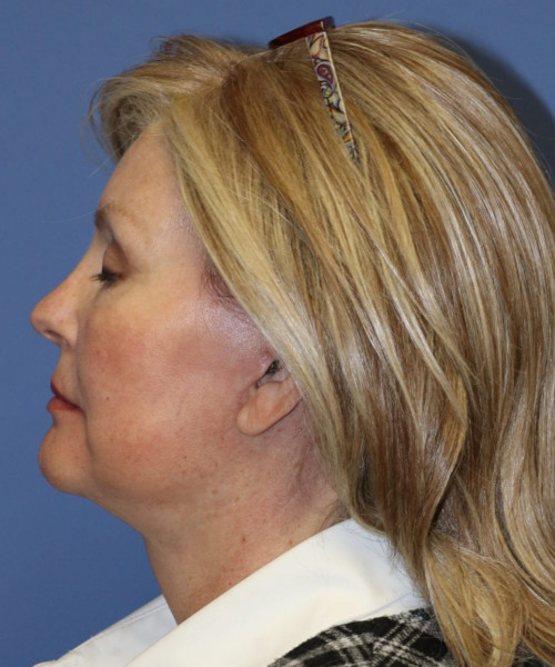 Facelift #6068 – click HERE for more views after photo. Individual results may vary.