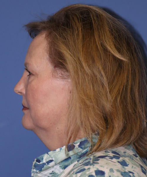 Facelift #6068 – click HERE for more views before photo. Individual results may vary.