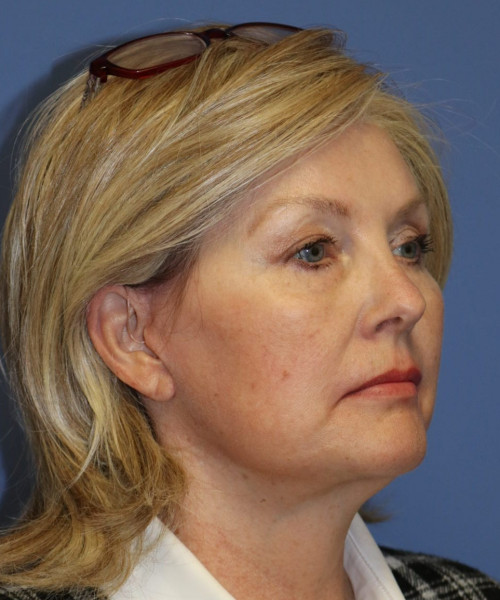 Facelift #6068 – click HERE for more views after photo. Individual results may vary.