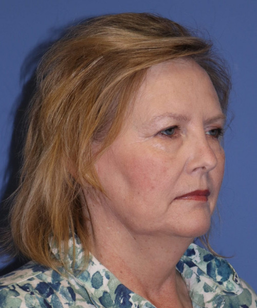 Facelift #6068 – click HERE for more views before photo. Individual results may vary.
