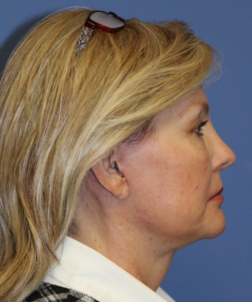 Facelift #6068 – click HERE for more views after photo. Individual results may vary.