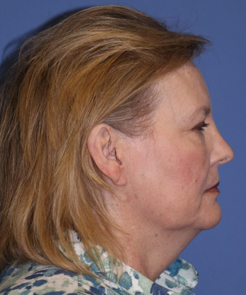 Facelift #6068 – click HERE for more views before photo. Individual results may vary.