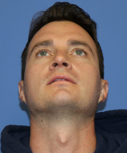 Rhinoplasty #6080 – click HERE for more views after photo. Individual results may vary.