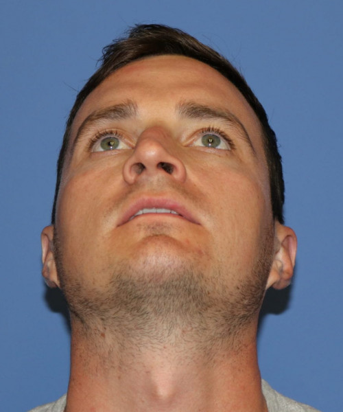 Rhinoplasty #6080 – click HERE for more views before photo. Individual results may vary.
