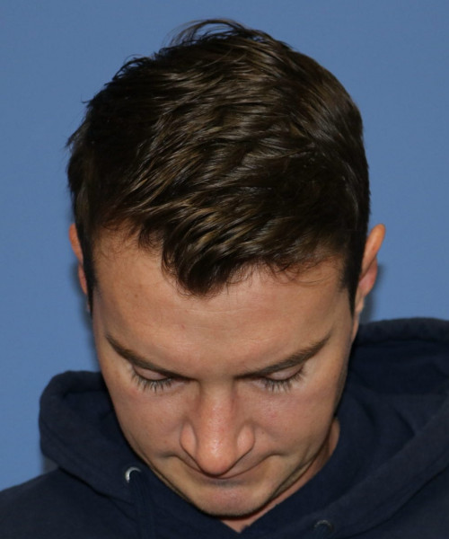 Rhinoplasty #6080 – click HERE for more views after photo. Individual results may vary.