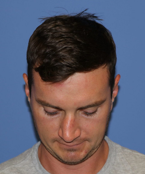 Rhinoplasty #6080 – click HERE for more views before photo. Individual results may vary.