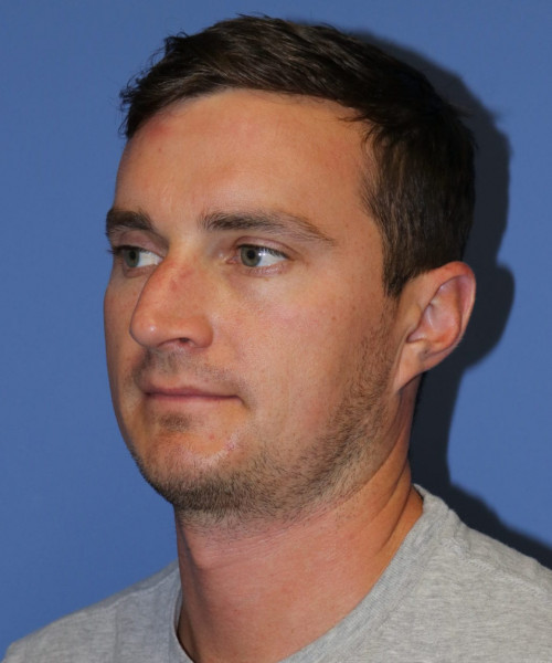 Rhinoplasty #6080 – click HERE for more views before photo. Individual results may vary.