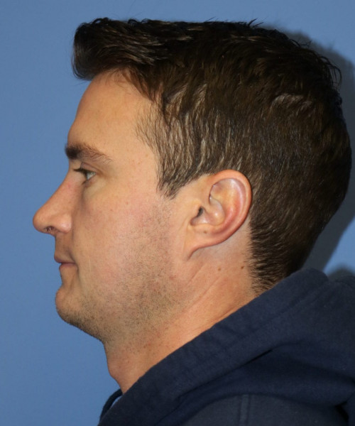 Rhinoplasty #6080 – click HERE for more views after photo. Individual results may vary.