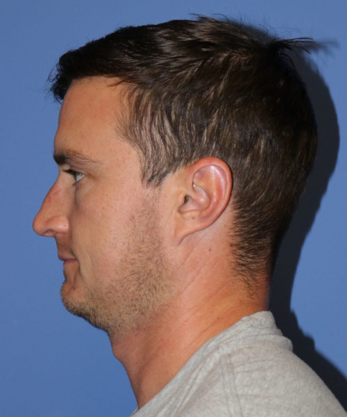 Rhinoplasty #6080 – click HERE for more views before photo. Individual results may vary.