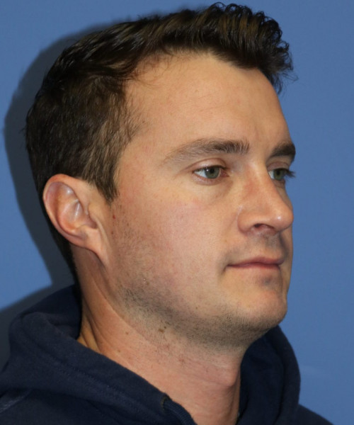Rhinoplasty #6080 – click HERE for more views after photo. Individual results may vary.