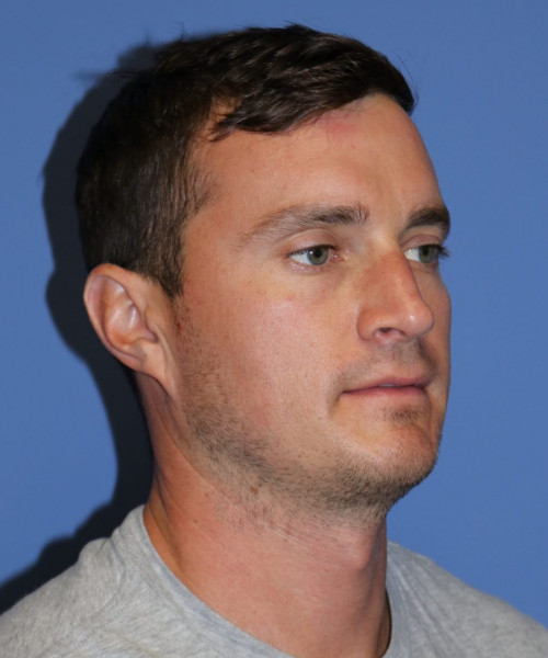 Rhinoplasty #6080 – click HERE for more views before photo. Individual results may vary.