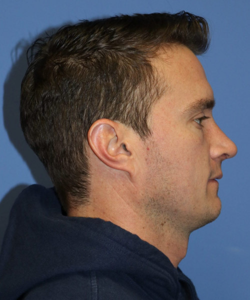 Rhinoplasty #6080 – click HERE for more views after photo. Individual results may vary.