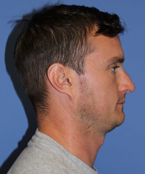 Rhinoplasty #6080 – click HERE for more views before photo. Individual results may vary.
