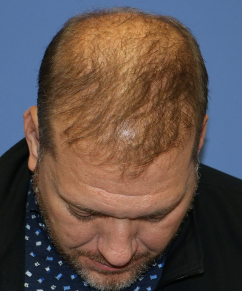 Hair Transplant #6115 – click HERE for more views after photo. Individual results may vary.