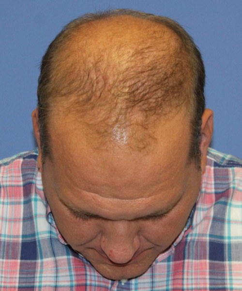 Hair Transplant #6115 – click HERE for more views before photo. Individual results may vary.