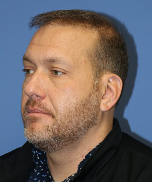 Hair Transplant #6115 – click HERE for more views after photo. Individual results may vary.