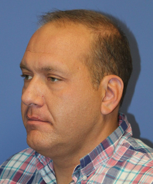 Hair Transplant #6115 – click HERE for more views before photo. Individual results may vary.
