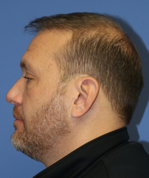 Hair Transplant #6115 – click HERE for more views after photo. Individual results may vary.