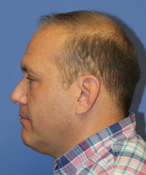 Hair Transplant #6115 – click HERE for more views before photo. Individual results may vary.