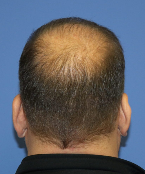 Hair Transplant #6115 – click HERE for more views after photo. Individual results may vary.