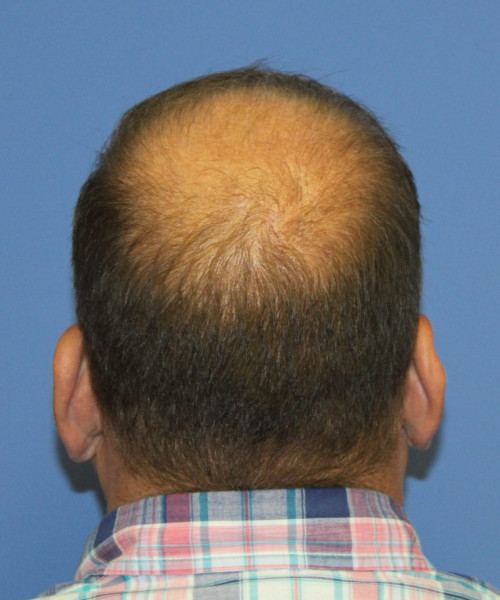 Hair Transplant #6115 – click HERE for more views before photo. Individual results may vary.