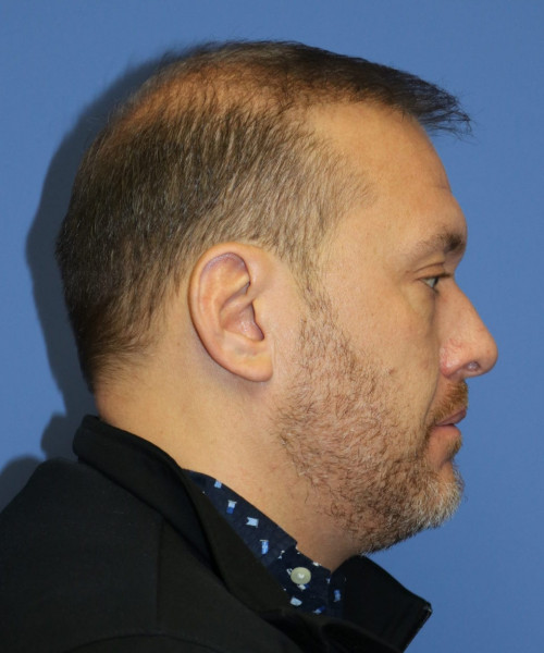 Hair Transplant #6115 – click HERE for more views after photo. Individual results may vary.
