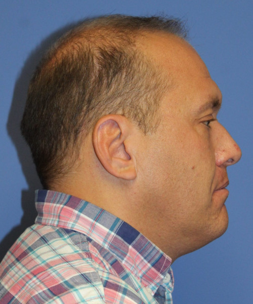 Hair Transplant #6115 – click HERE for more views before photo. Individual results may vary.