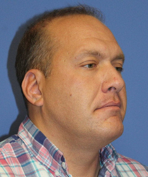 Hair Transplant #6115 – click HERE for more views before photo. Individual results may vary.