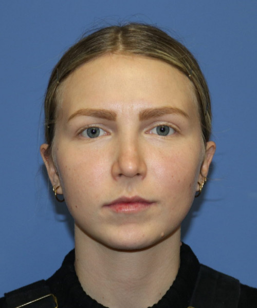 Rhinoplasty #6117 – click HERE for more views after photo. Individual results may vary.
