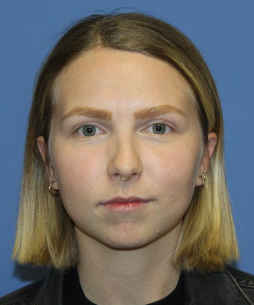 Rhinoplasty #6117 – click HERE for more views before photo. Individual results may vary.