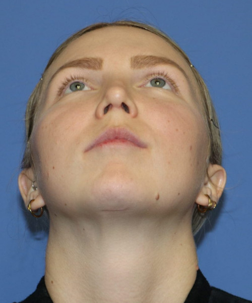 Rhinoplasty #6117 – click HERE for more views after photo. Individual results may vary.