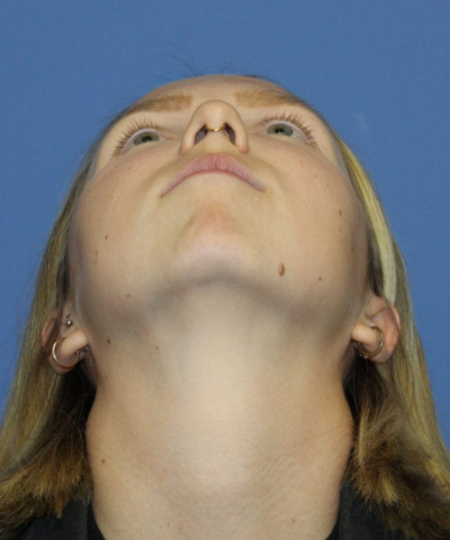Rhinoplasty #6117 – click HERE for more views before photo. Individual results may vary.