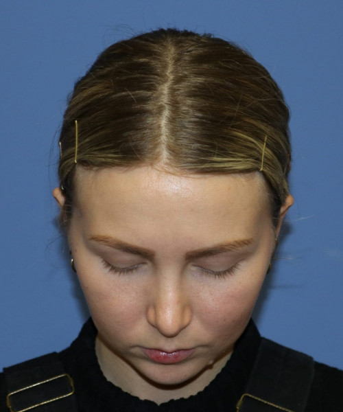 Rhinoplasty #6117 – click HERE for more views after photo. Individual results may vary.