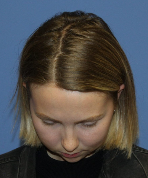 Rhinoplasty #6117 – click HERE for more views before photo. Individual results may vary.