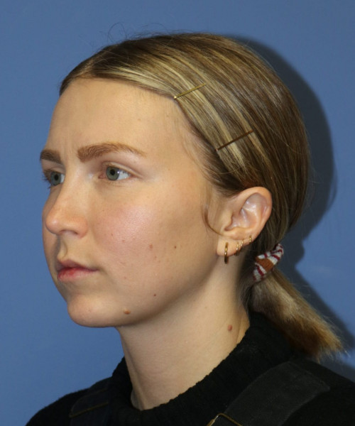 Rhinoplasty #6117 – click HERE for more views after photo. Individual results may vary.