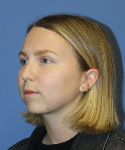 Rhinoplasty #6117 – click HERE for more views before photo. Individual results may vary.