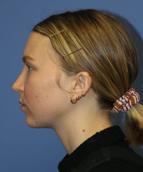 Rhinoplasty #6117 – click HERE for more views after photo. Individual results may vary.