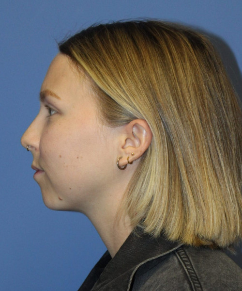 Rhinoplasty #6117 – click HERE for more views before photo. Individual results may vary.