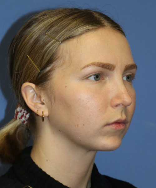 Rhinoplasty #6117 – click HERE for more views after photo. Individual results may vary.
