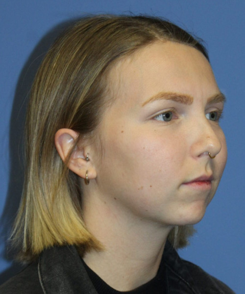 Rhinoplasty #6117 – click HERE for more views before photo. Individual results may vary.