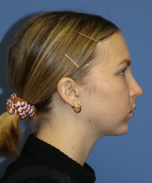 Rhinoplasty #6117 – click HERE for more views after photo. Individual results may vary.