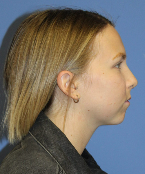 Rhinoplasty #6117 – click HERE for more views before photo. Individual results may vary.