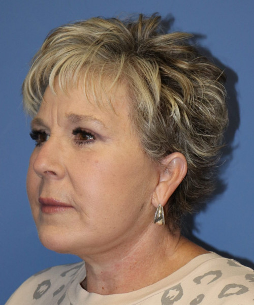 Facelift #6148 – click HERE for more views after photo. Individual results may vary.