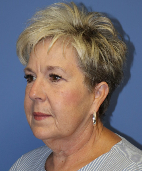 Facelift #6148 – click HERE for more views before photo. Individual results may vary.