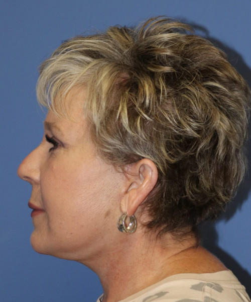 Facelift #6148 – click HERE for more views after photo. Individual results may vary.