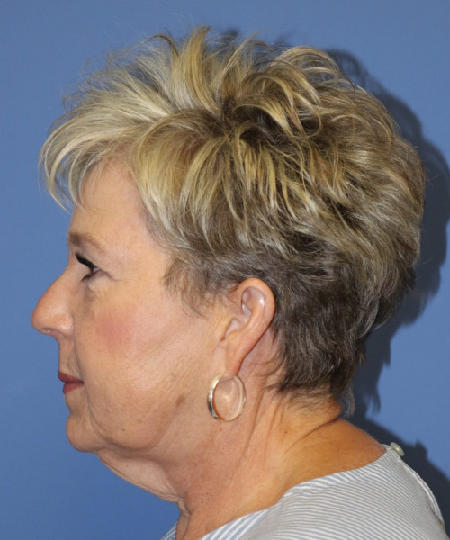 Facelift #6148 – click HERE for more views before photo. Individual results may vary.
