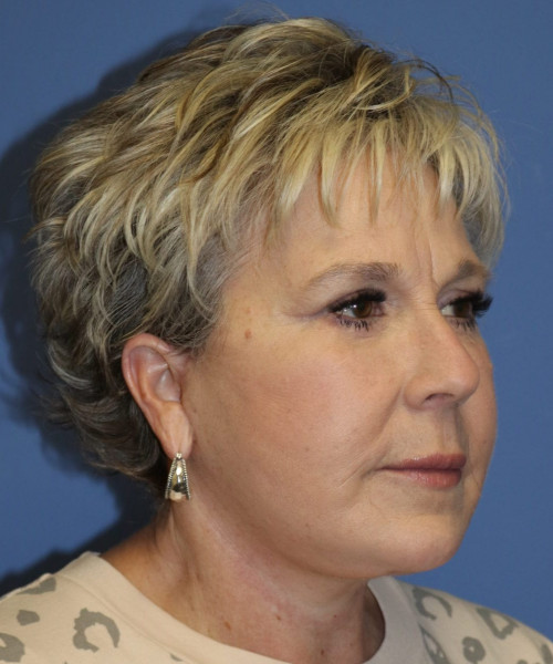 Facelift #6148 – click HERE for more views after photo. Individual results may vary.