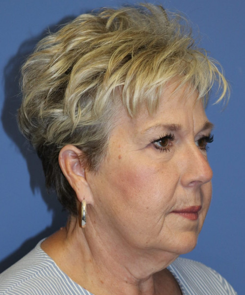 Facelift #6148 – click HERE for more views before photo. Individual results may vary.