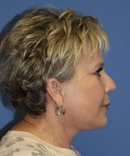 Facelift #6148 – click HERE for more views after photo. Individual results may vary.