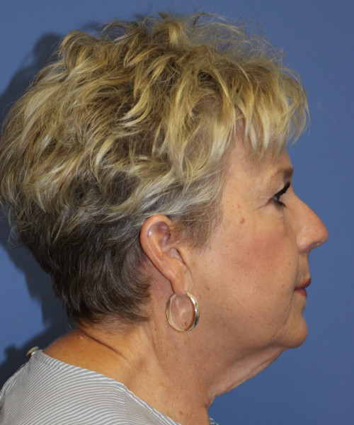 Facelift #6148 – click HERE for more views before photo. Individual results may vary.